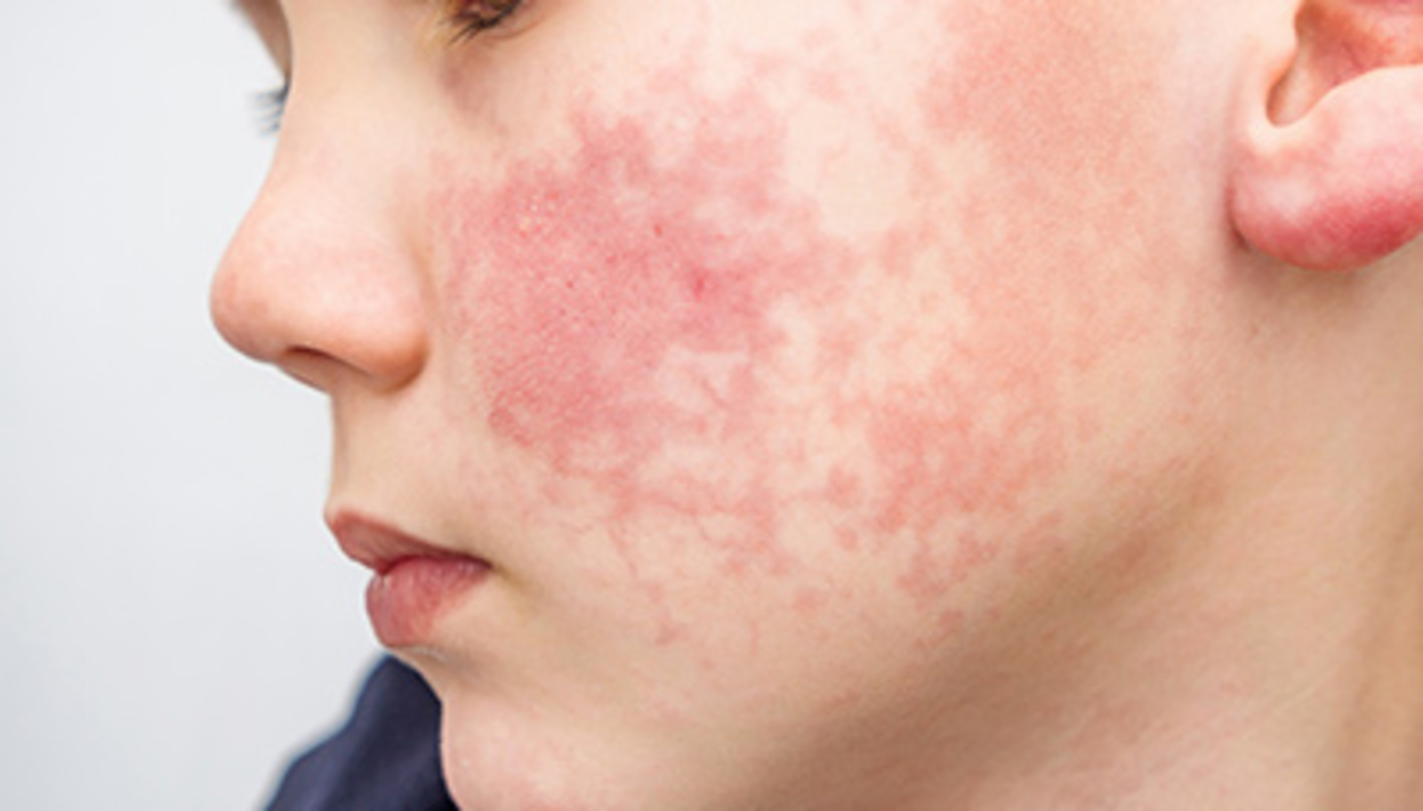 Баланың тәненә тимгелләр чыга...